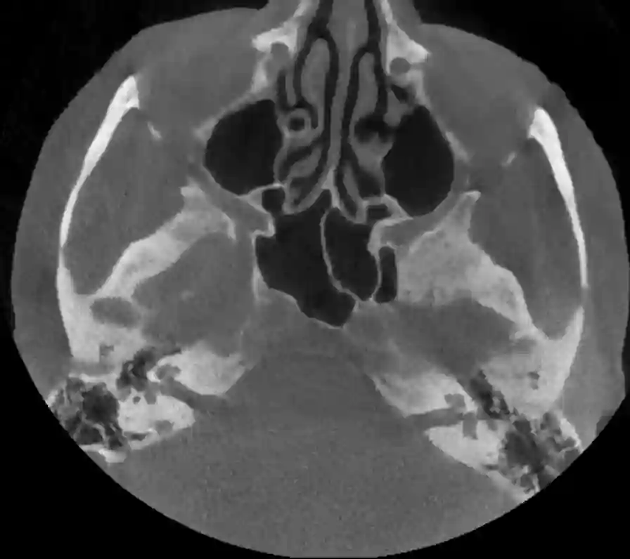 Axiales CT Bild des Felsenbeins
