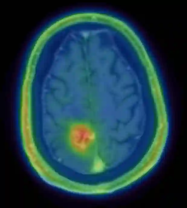 FET-PET CT bei einem Glioblastom