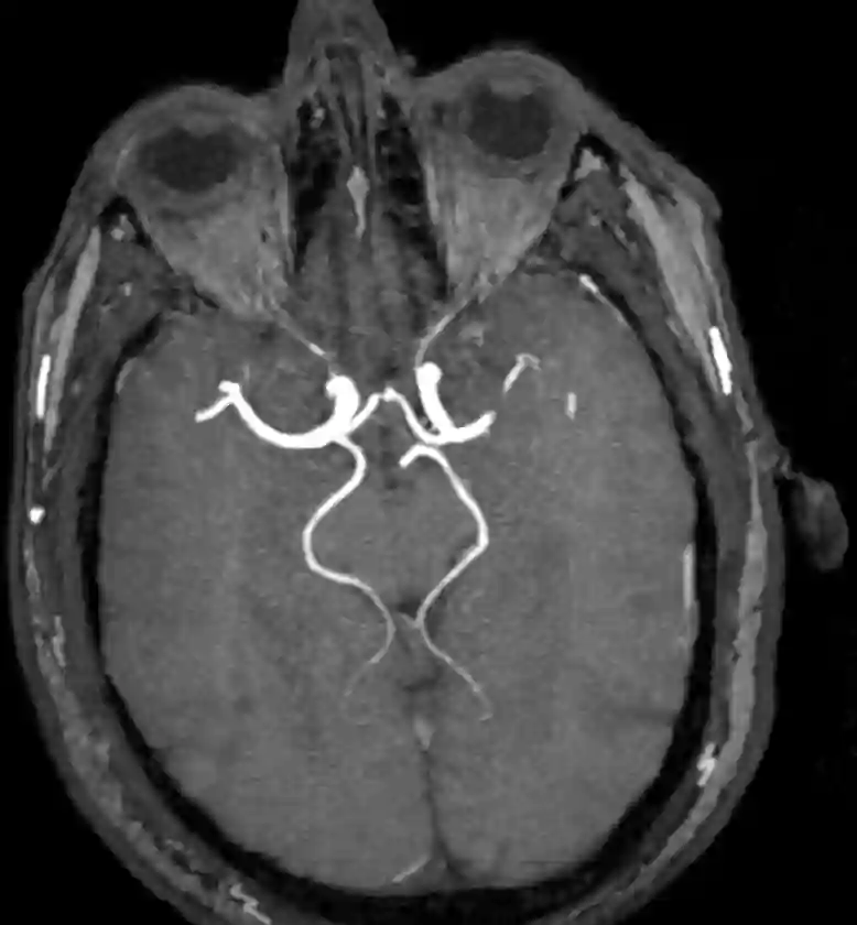 fetale PCOM MRI