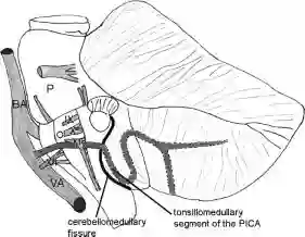 Schematische Zeichnung der Fissura cerebellomedullaris