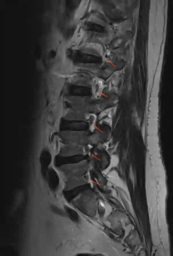 Foramen intervertebrale MRI