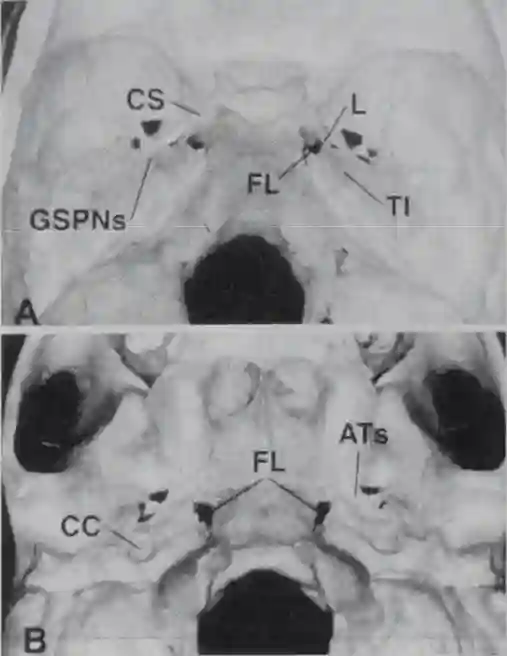Foramen lacerum