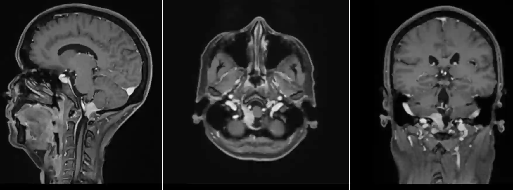 Foramen magnum Meningeom im MRI