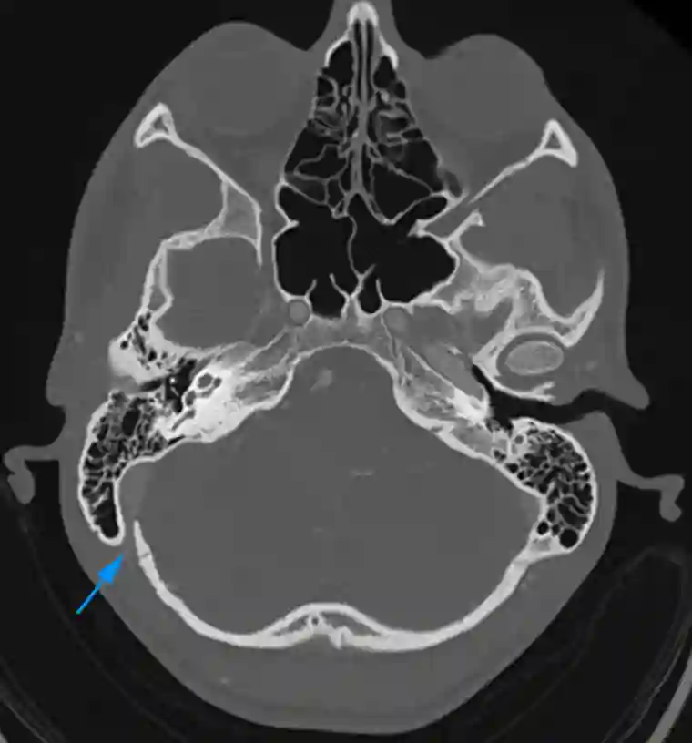 Foramen mastoideum im CT