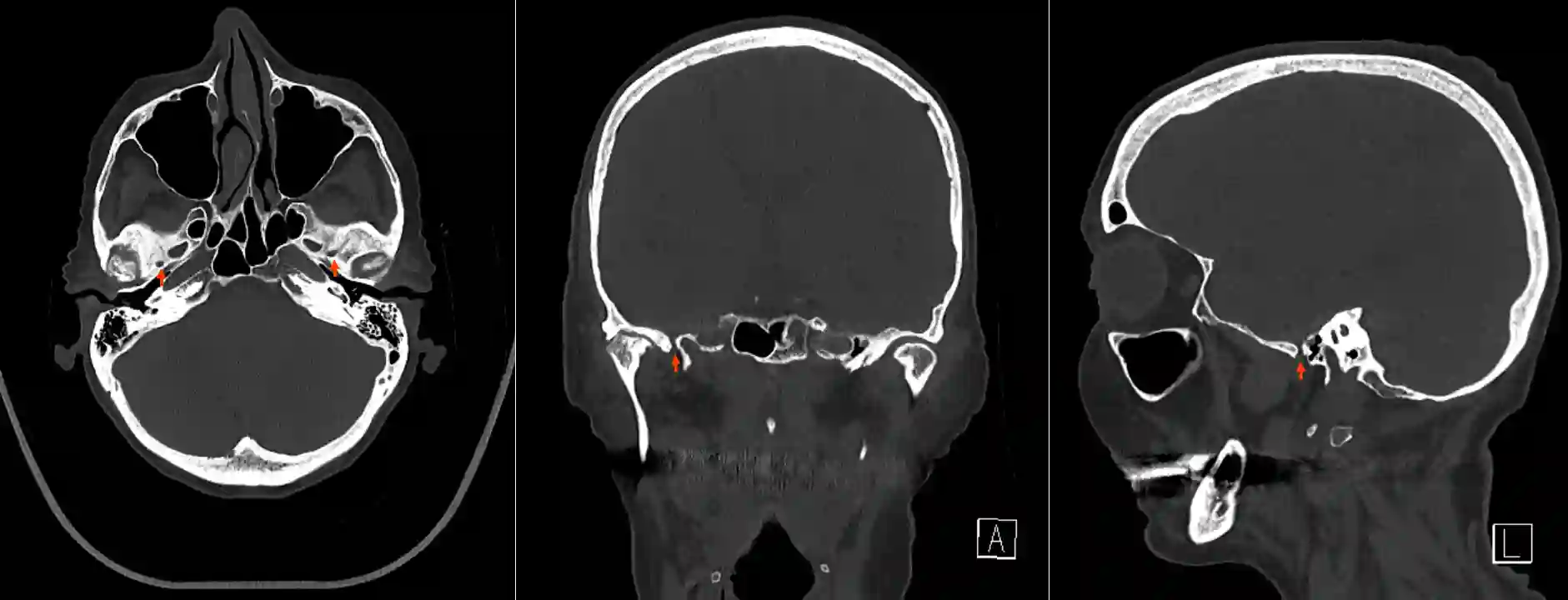 Foramen spinosum im CT.