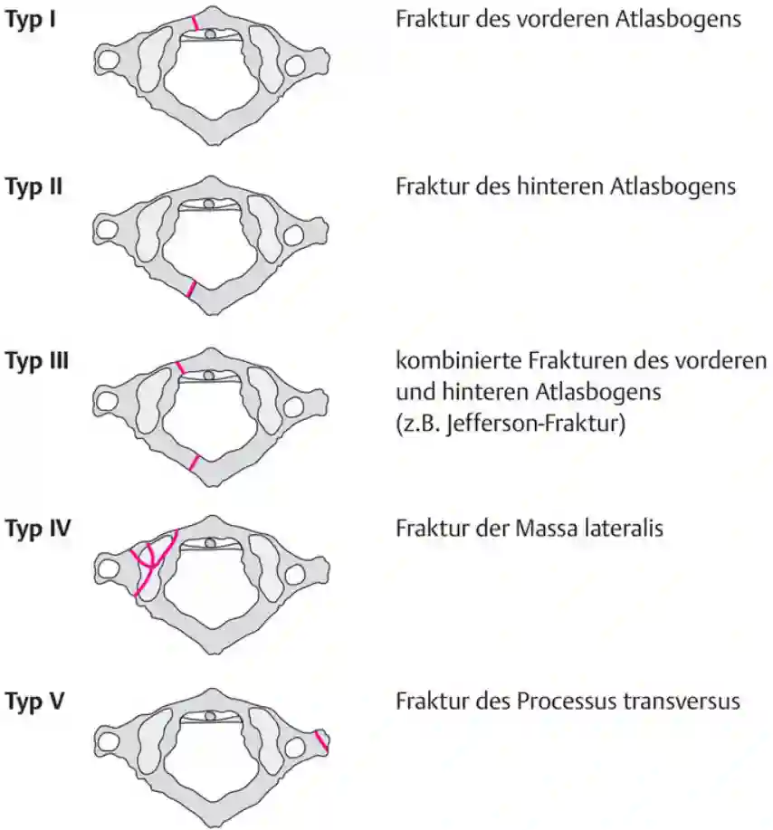 Gehweiler Klassifikation
