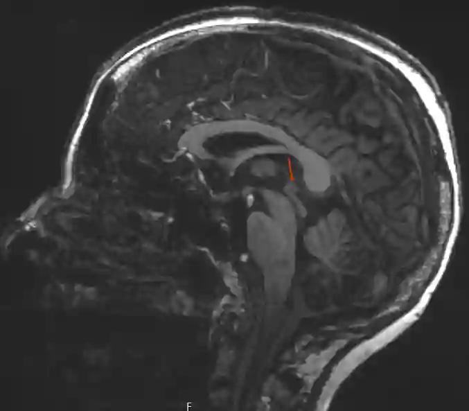 Glandula pinealis im MRI