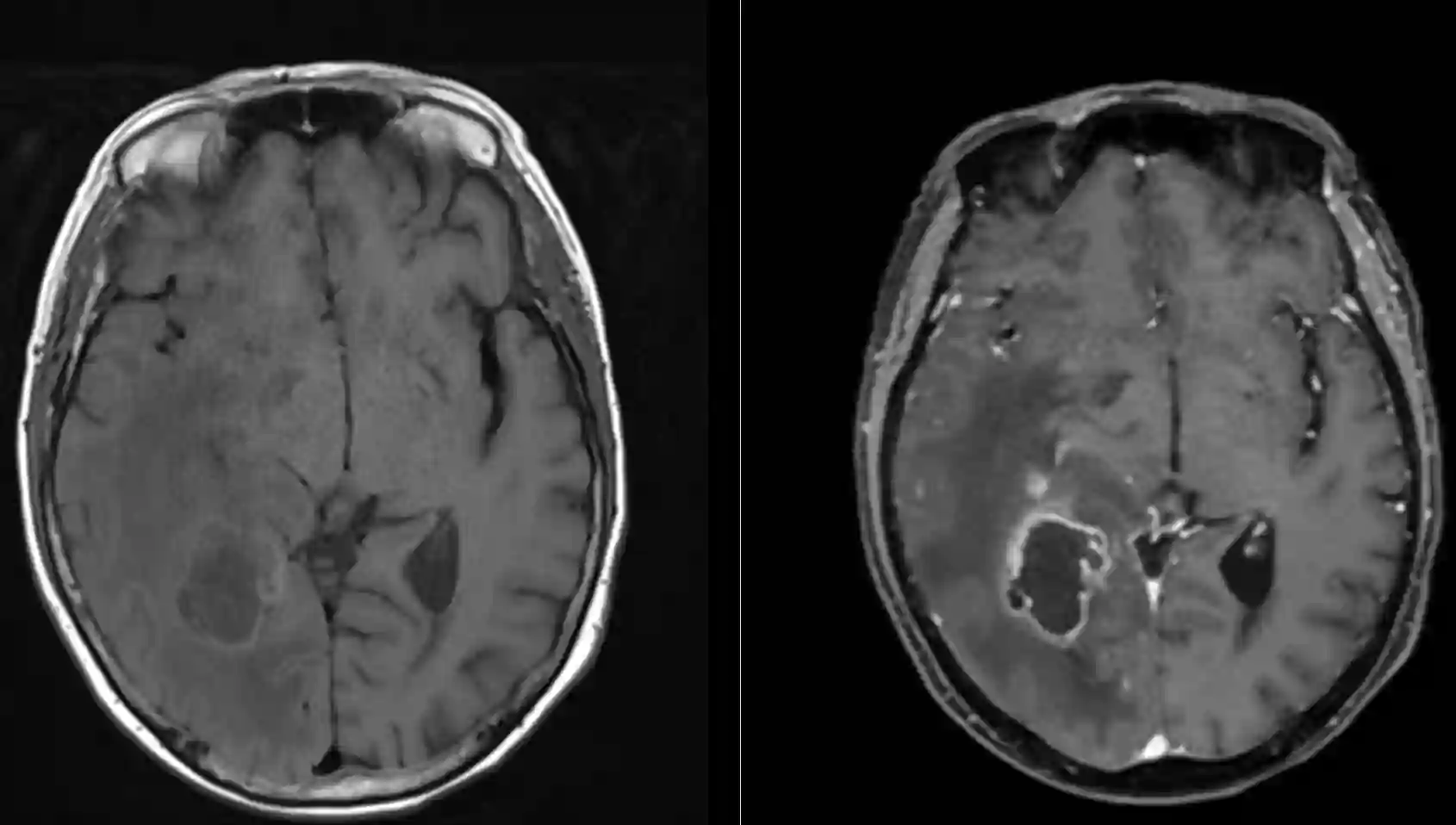 Glioblastom im MRI