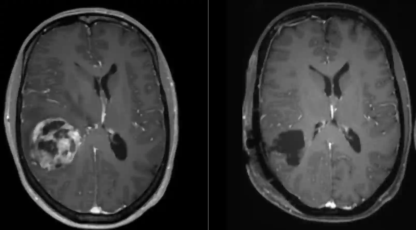 Preoperativ und postoperative Bildgebung bei einem Glioblastom im MRI
