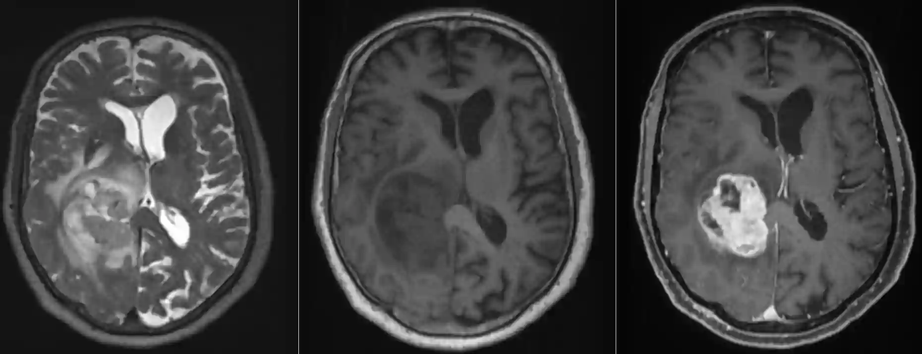 Gliosarkom im MRI