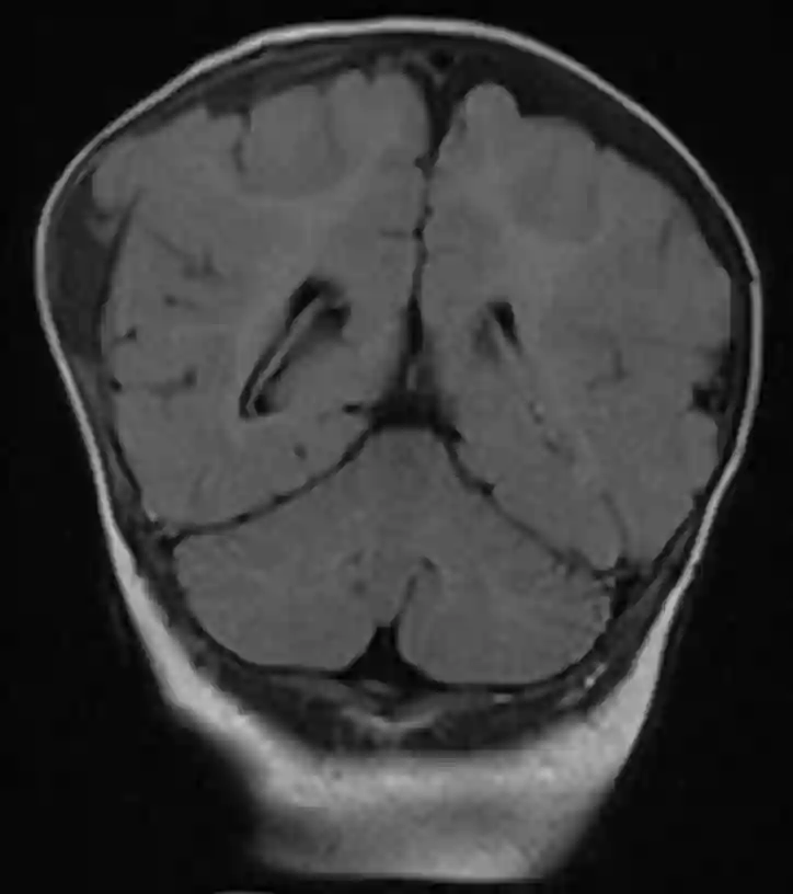 MRI einer wachsenden Schädelfraktur, auch bekannt als Growing skull fracture