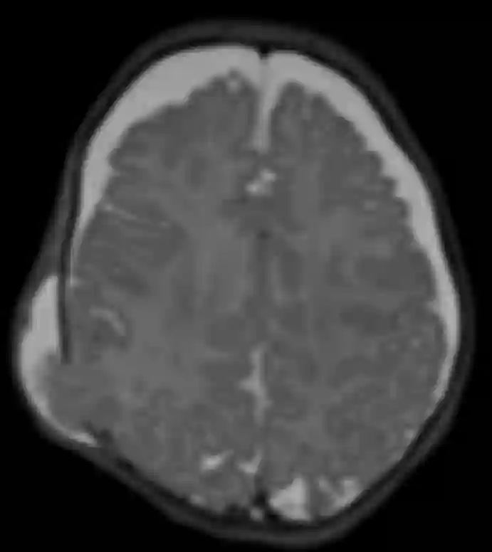T2 MRI Sequenz einer wachsenden Schädelfraktur, auch bekannt als Growing skull fracture