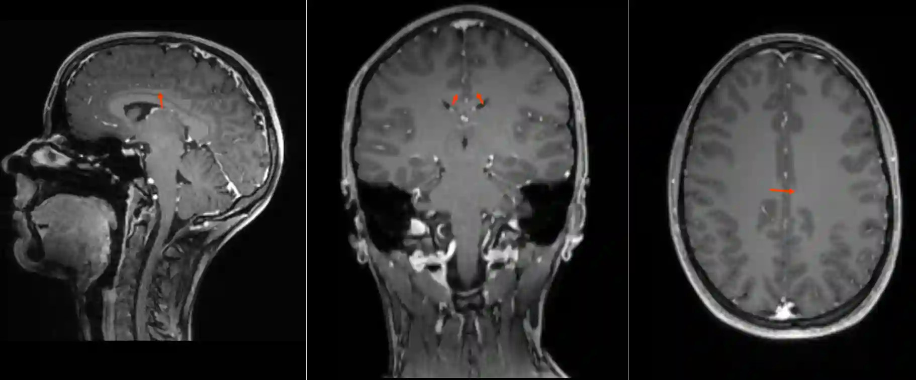 Gyrus cinguli im MRI