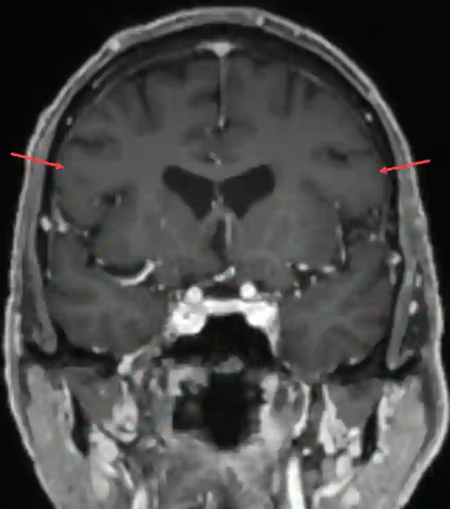 Gyrus frontalis inferior im MRT