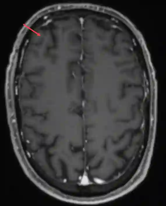 Axiales MRI Bild des Gyrus frontalis medius