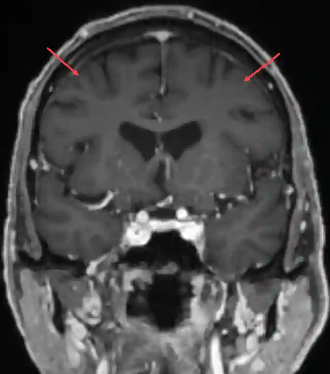 Coronales MRI Bild des Gyrus frontalis medius