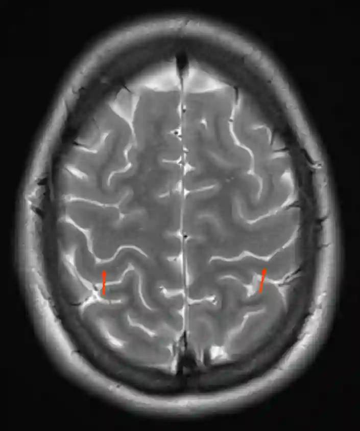 Gyrus postcentralis im MRI