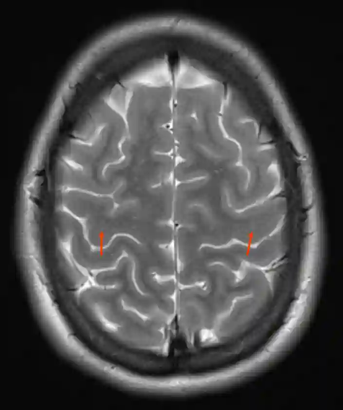 Gyrus precentralis im MRI