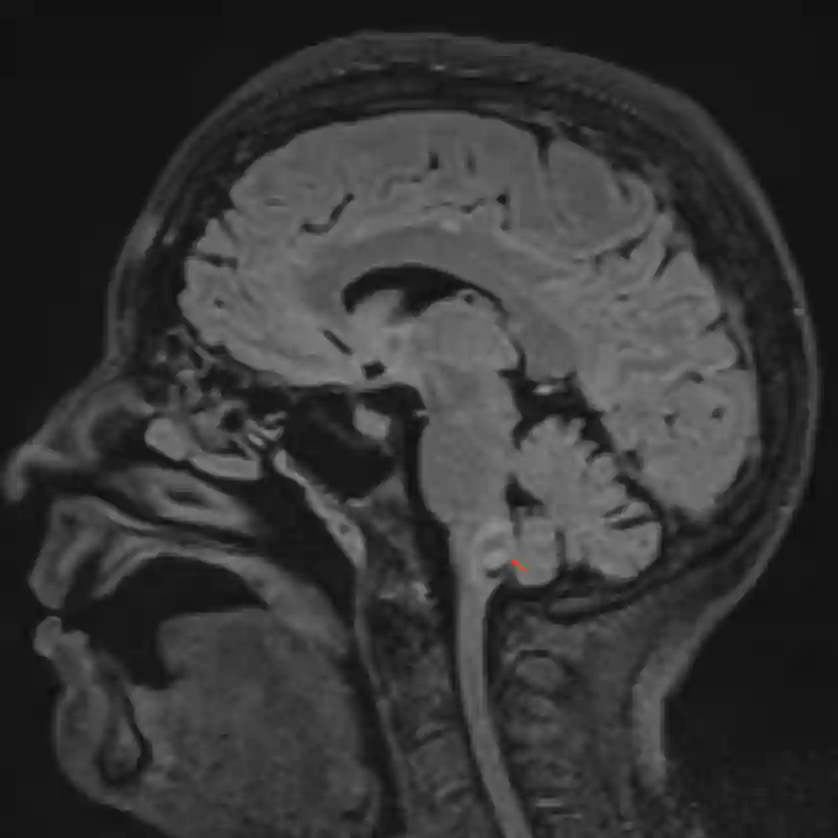 MRT eines Kavernoms in der dorsolateralen Medulla oblongata