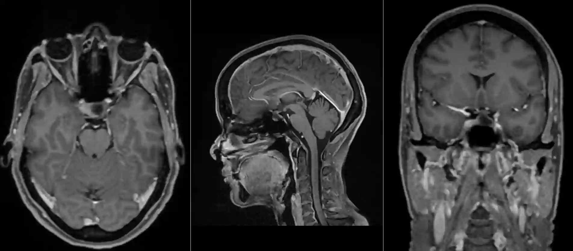 Hypophysenmesoadenom im MRI