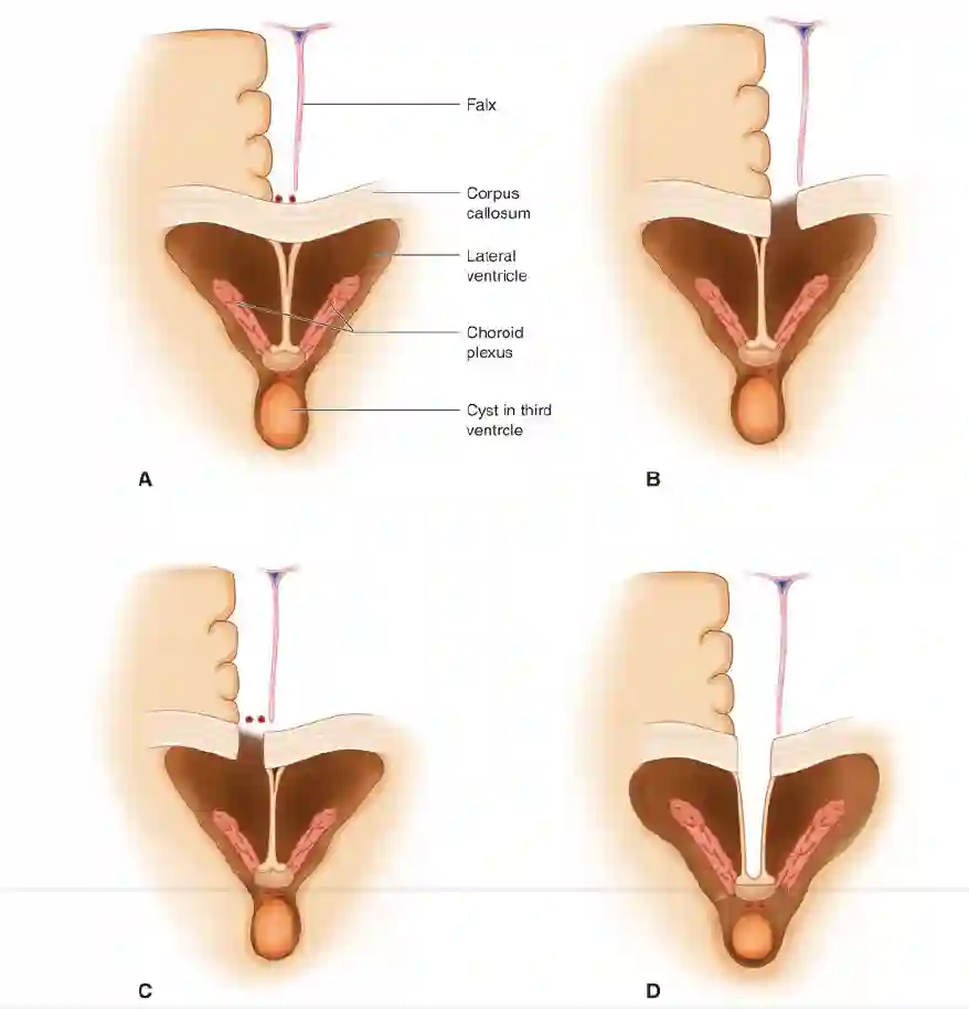 Interhemisphärischer transcallosaler Zugang