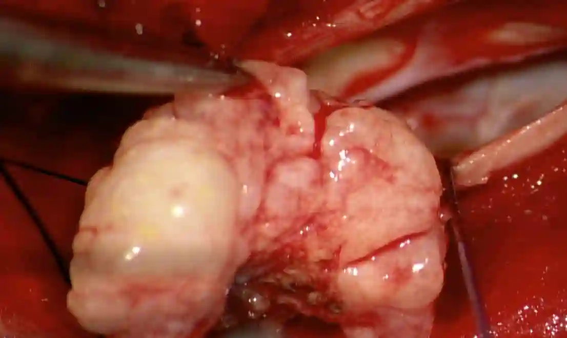 Spinales Meningeom