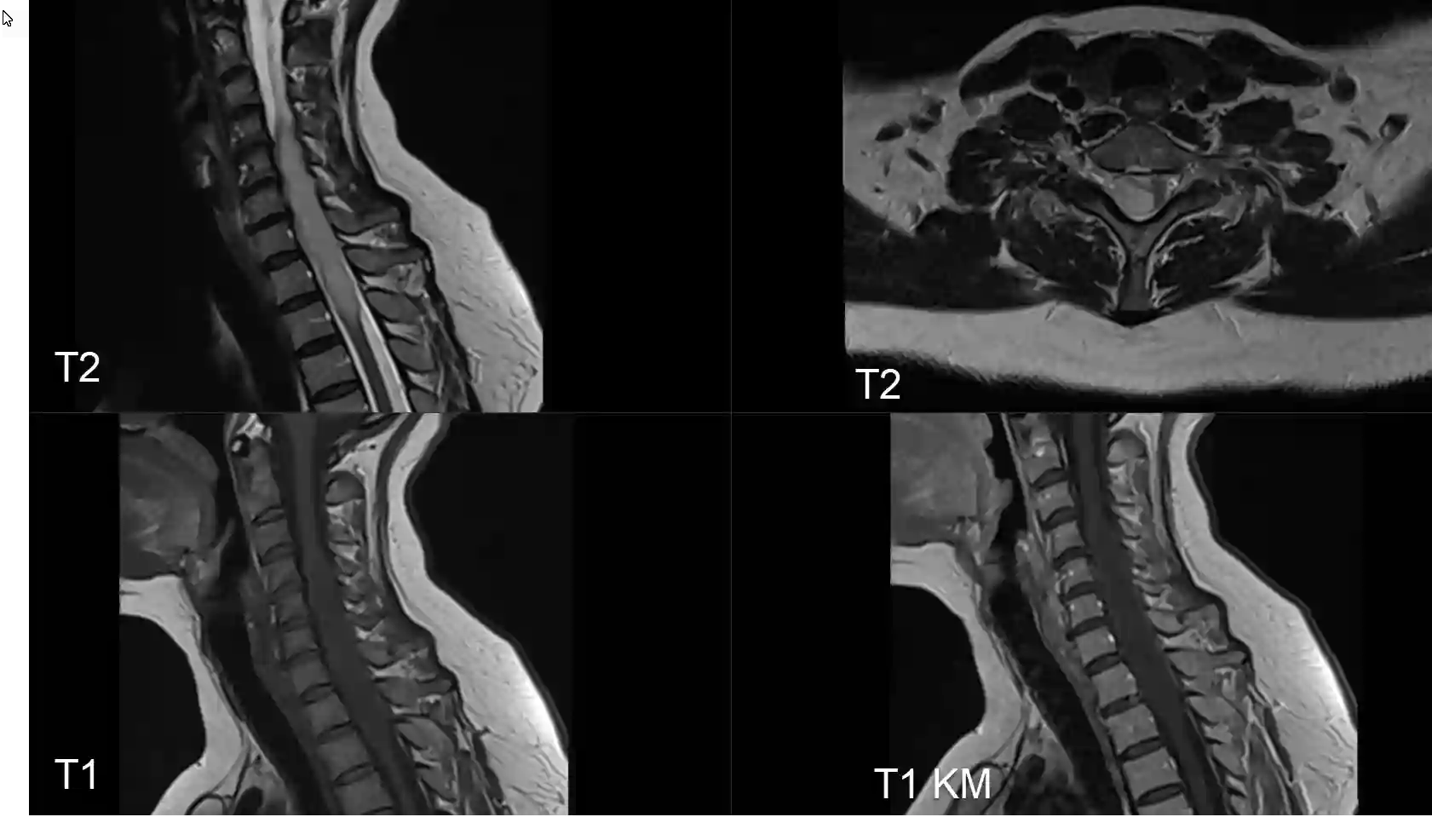 Intramedulläres Subependymom MRi