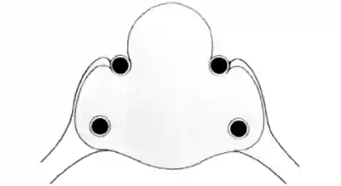 Knosp Grad 4