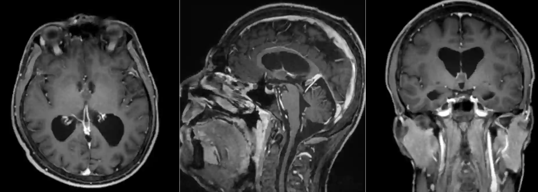 Kolloidzyste im MRI