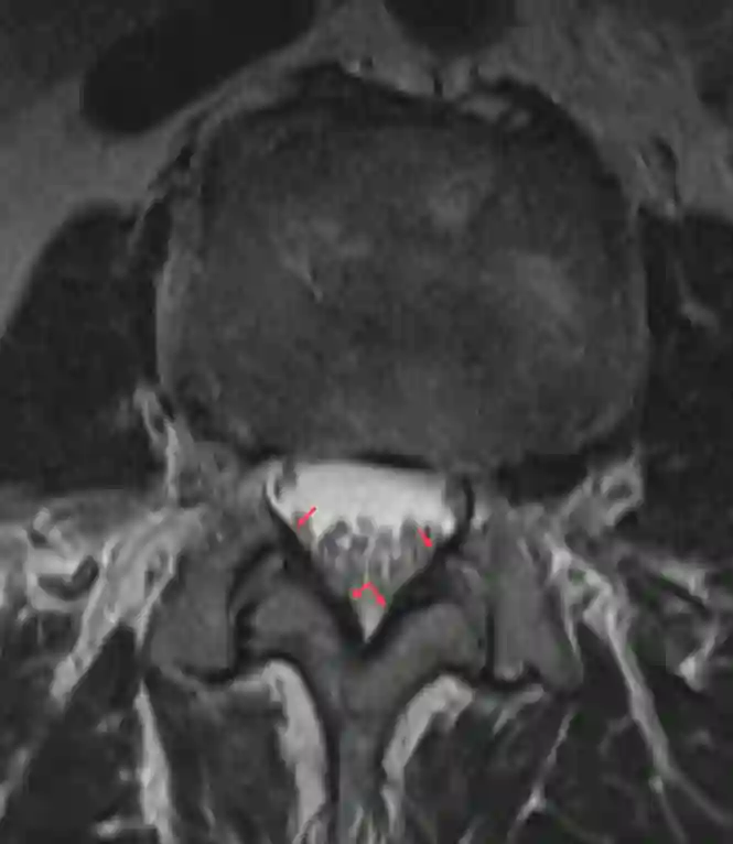 Ligamentum flavum im MRI