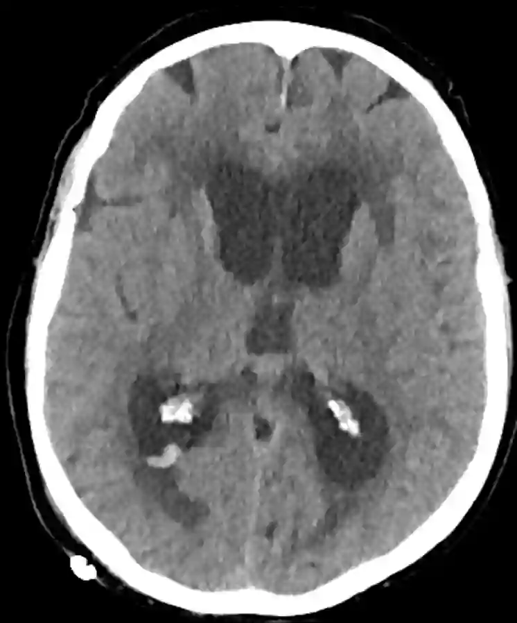 CT mit Liquordiapedese