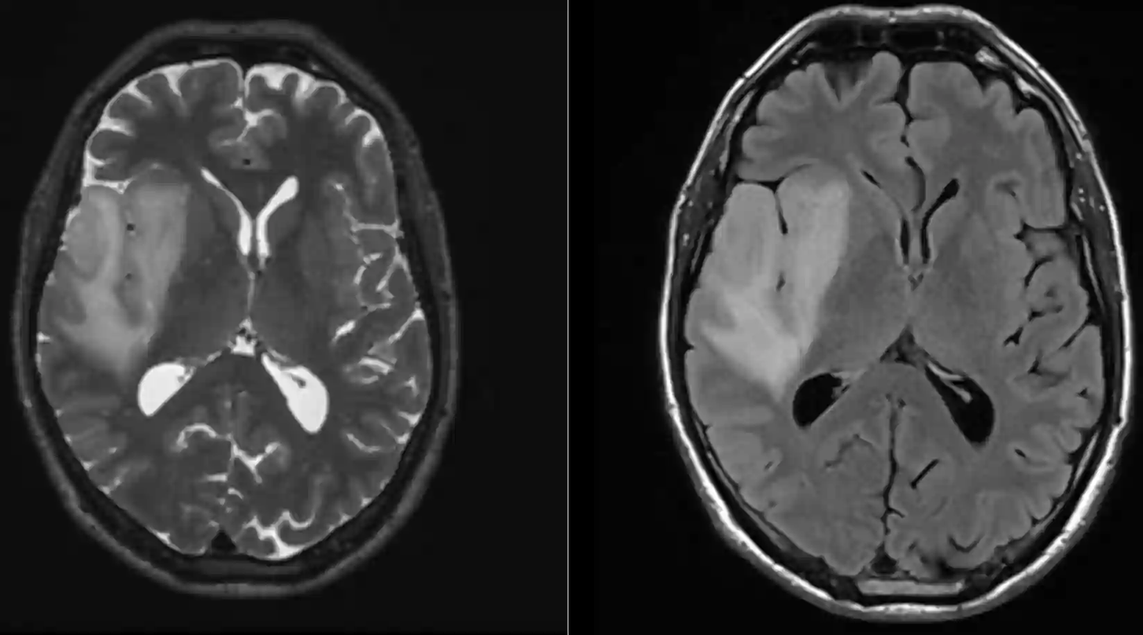 Low grade Gliom im MRI