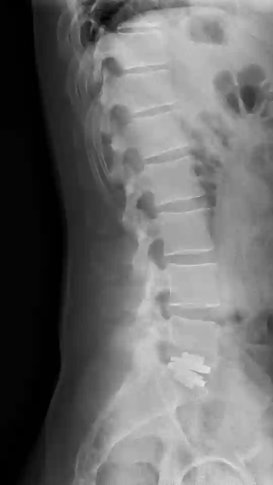 Röntgen lumbale Bandscheibenprothese