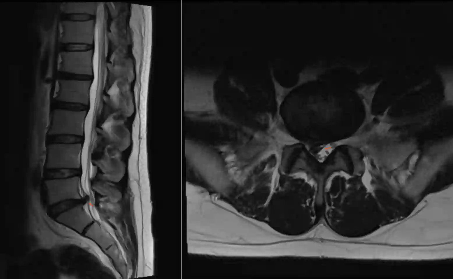 Lumbaler Bandscheibenvorfall im MRI