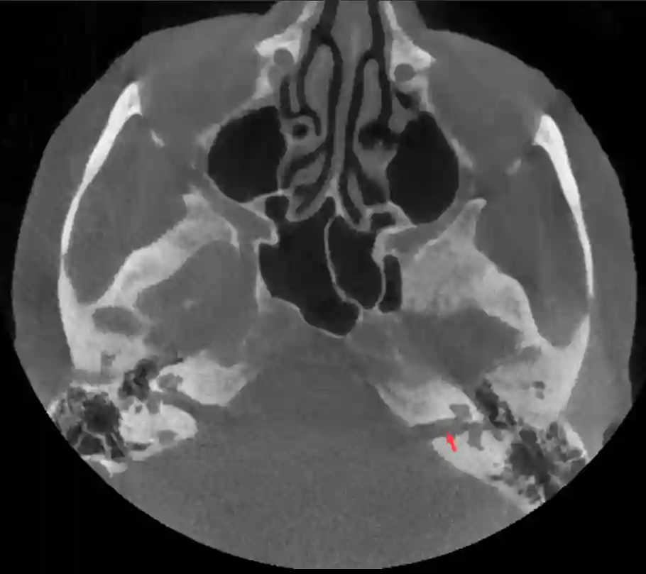 Meatus actusticus internus im CT