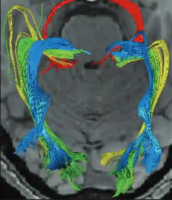 Meyers Loop MRI