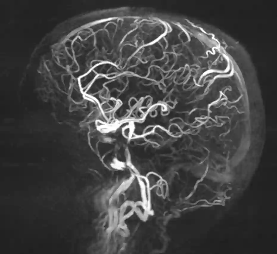 MR-Angiographie 7 Tesla
