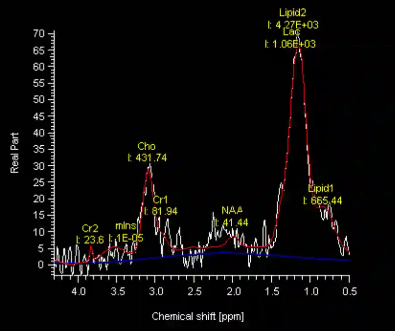 MR-Spektroskopie Lymphom