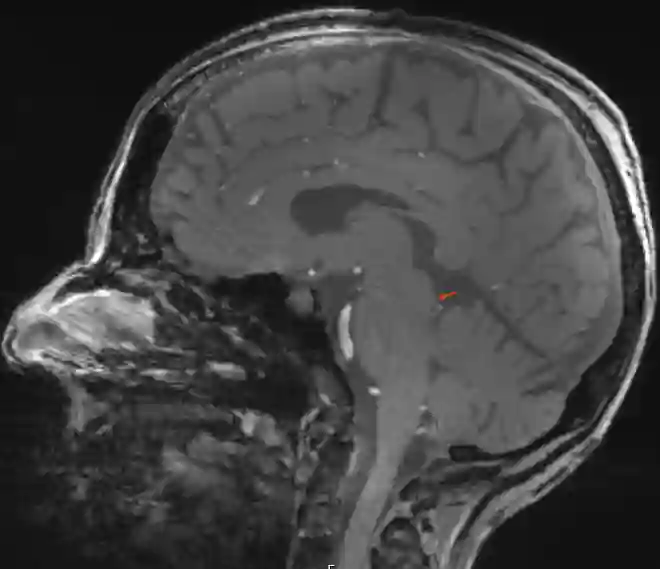 MRI Abbildung des Colliculus inferior
