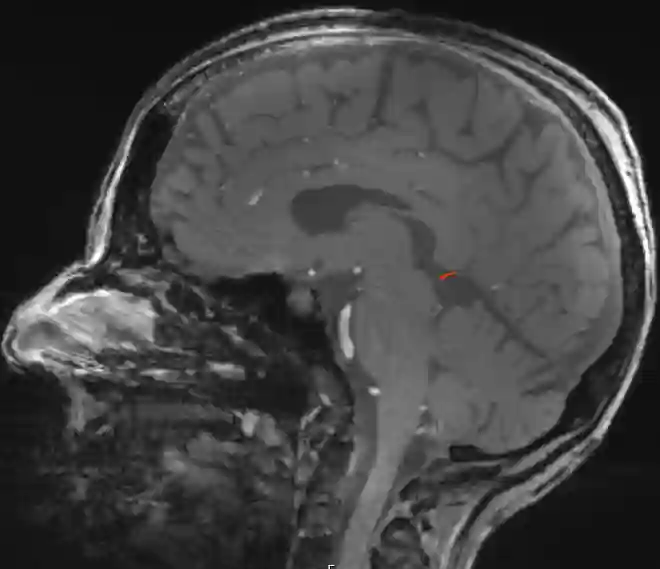 MRI Abbildung des Colliculus superior