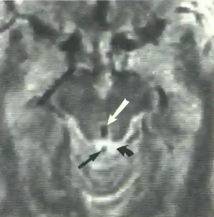 Flow Void Signal MRI