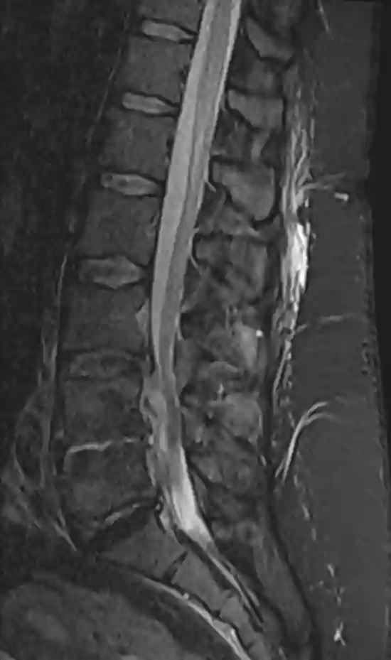 MRI STIR Sequenz der Wirbelsäule