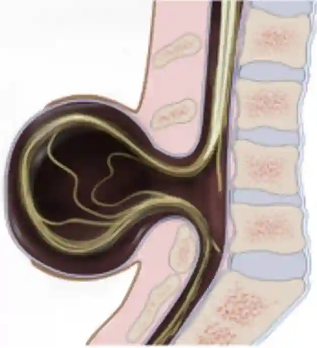 Schematische Myelomeningozele.