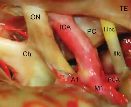 Petroclinoidales Segment des Nervus oculomotorius
