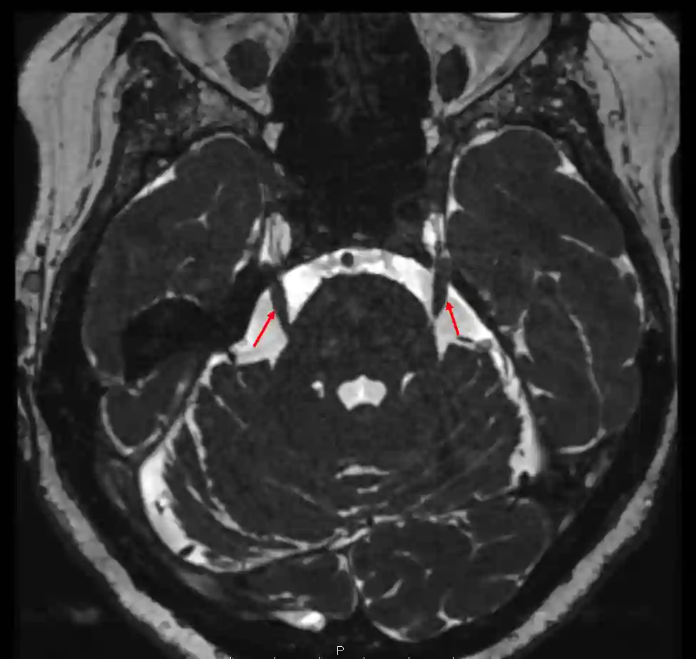 Nervus trigeminus im MRI