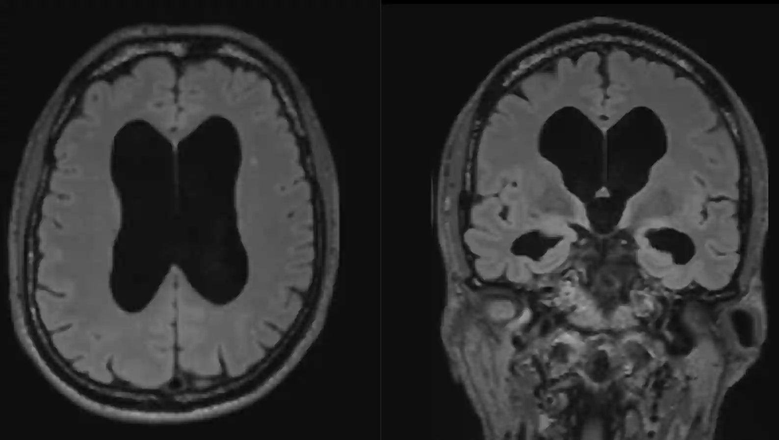 Normaldruckhydrocephalus MRI