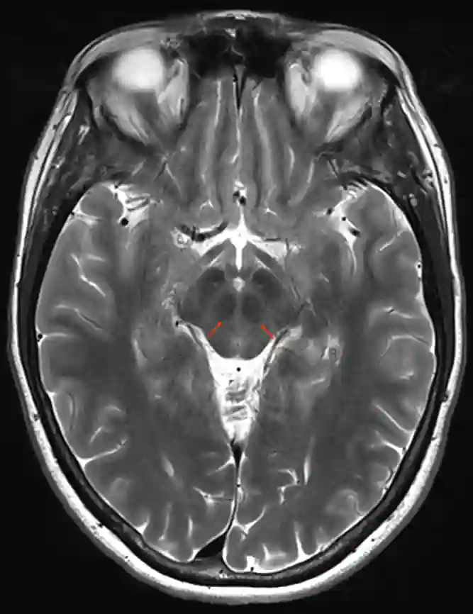 Nucleus ruber im MRI]