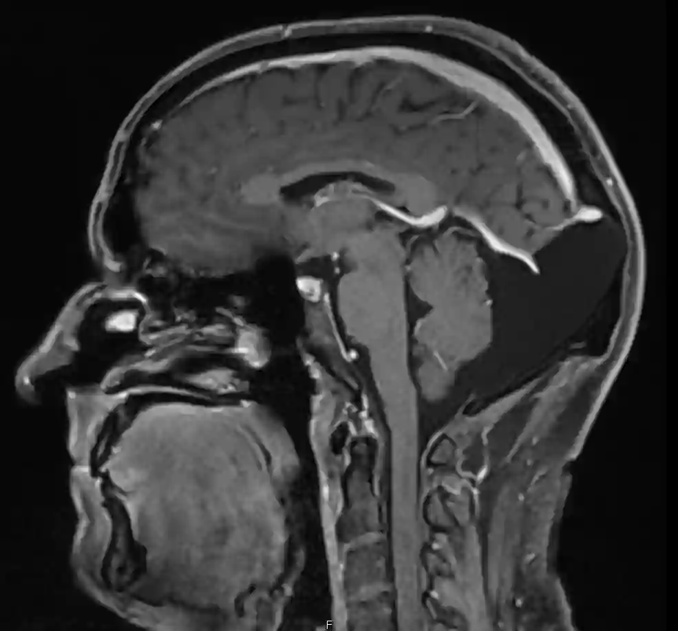 Occipitale Arachnoidalzyste im MRI