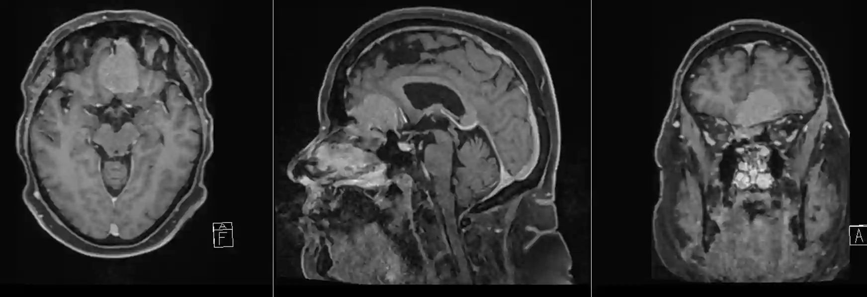 Olfaktoriusmeningeom MRI