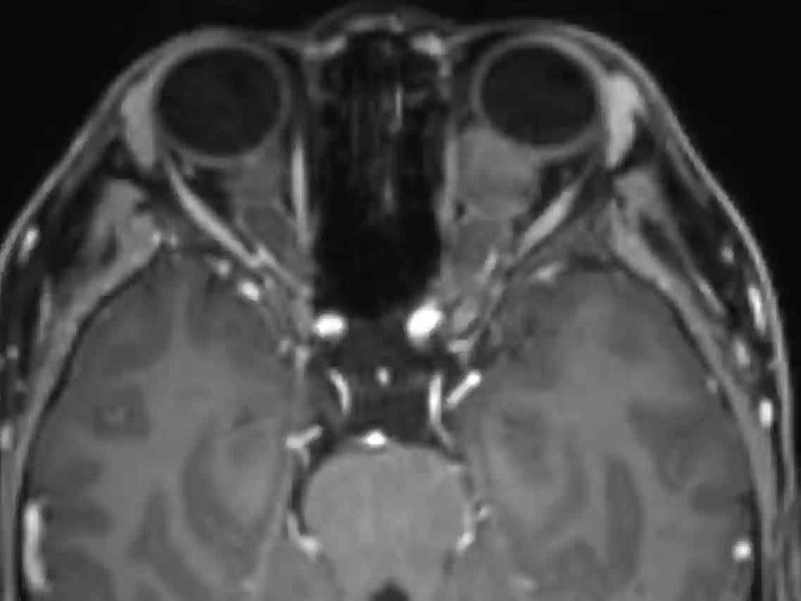 Optikusgliom im MRI